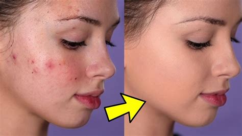 Enhance your beauty spell with bewitching blemish cover up techniques